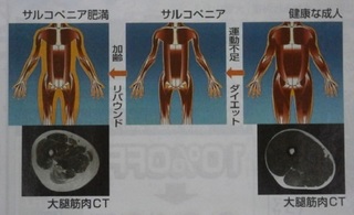 サルコペニア.jpg