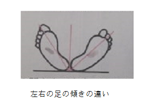 違い左右の足の傾きの.png